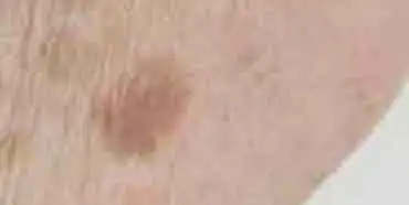 Sun Spots & Age Spots