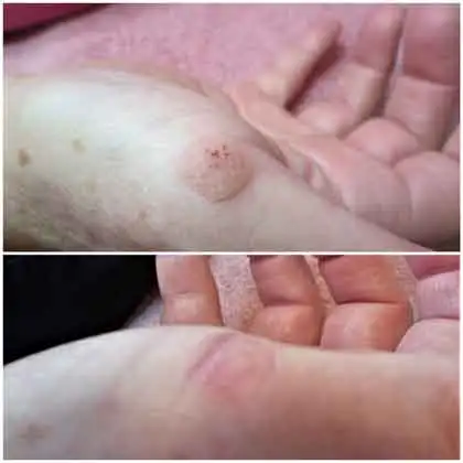 Warts