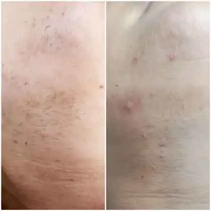 Hair Removal
