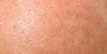 Red Thread Veins