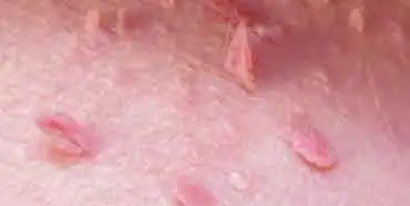 Skin Tags