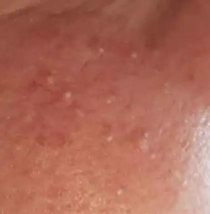 White Milia Spots