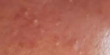 White Milia Spots