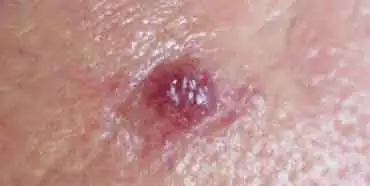 Blood Spots