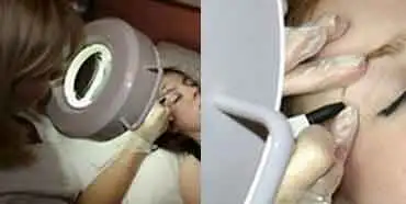 Hair Removal
