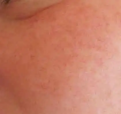 Red Thread Veins