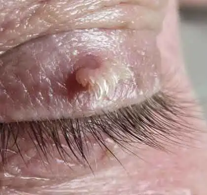 Skin Tag Removal