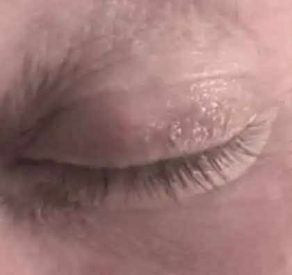 Skin Tags